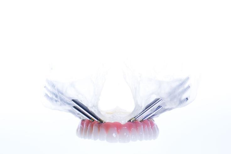 Napredne implantološke rešitve All-on-X omogočajo trajno rehabilitacijo tudi pri zahtevnejših primerih brezzobosti. | Foto: ORTOIMPLANT DENTAL SPA