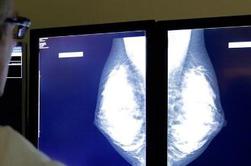 Rak dojke ima visoko stopnjo ozdravljivosti