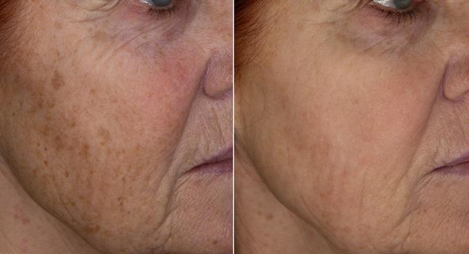 Primer kože obraza pred in po posegu s tehnologijo Nordlys SWT. Vidno je zmanjšanje hiperpigmentacij, rdečine in drobnih gubic.  | Foto: 