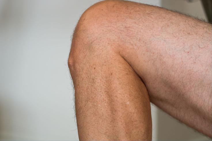 Medicofit, Osgood Schlatter sindrom | Foto: Medicofit