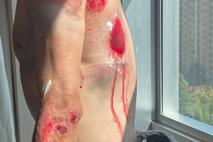 THUMB - Rui Oliveira, padec
