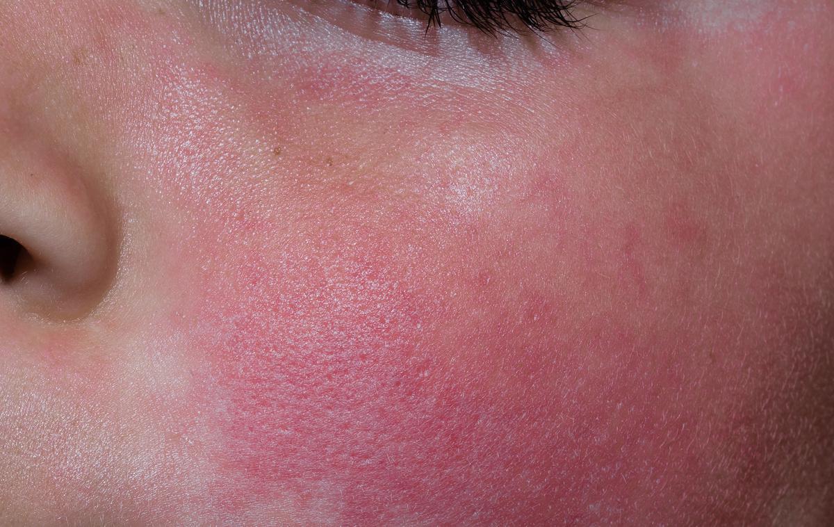 peta bolezen | "Zaradi živordeče barve izpuščaja starši mislijo, da ima otrok kakšno alergijo," je za N1 povedal pediater iz kamniškega zdravstvenega doma Denis Baš. | Foto Shutterstock