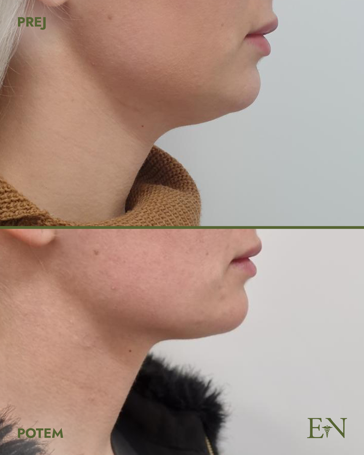 NeckDefine Pro+ zagotavlja naraven in dolgotrajen rezultat. | Foto: Dr. Ernest Novak