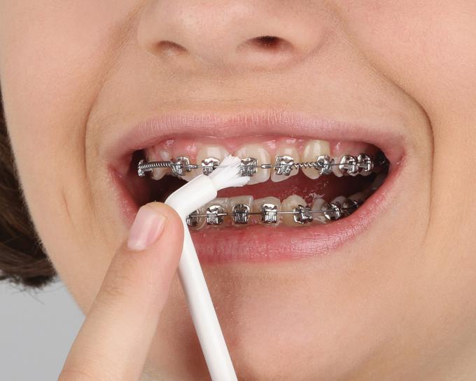 Ščetka z enim snopom ščetin se odlično obnese pri ščetkanju zob ob stiku z nosilcem fiksnega ortodontskega aparata. Poščetkati je treba okrog in okrog vsakega nosilca posebej. | Foto: Curaprox