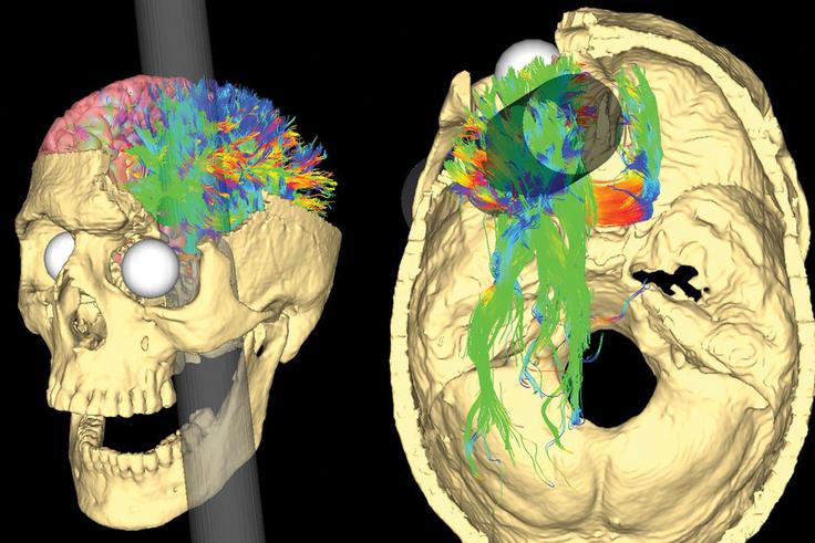 Grafični prikaz poškodbe, ki jo je utrpel Phineas Gage.  | Foto: Wikimedia Commons