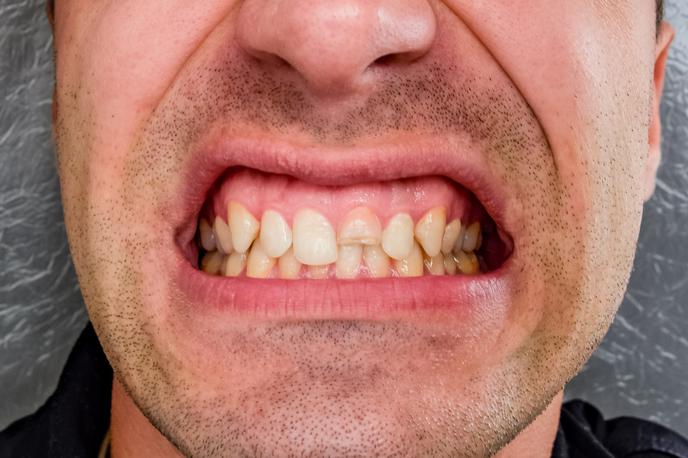 dlesni | Raziskava znanstvenikov univerze Illinois v Chicagu je pokazala, da je ista bakterija, ki povzroča bolezni dlesni, lahko tudi poglavitni patogeni vzrok Alzheimerjeve bolezni.  | Foto Getty Images