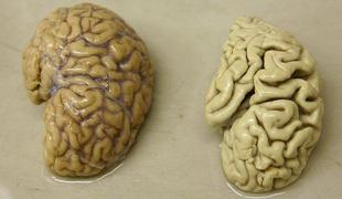 Možganski spodbujevalniki rešitev za alzheimerjevo bolezen?