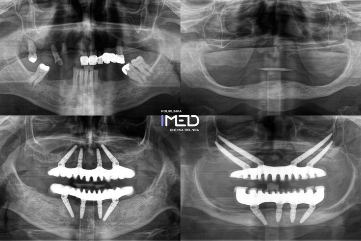 RTG-prikaz All-on-4 dela na levi strani in zigomatičnih implantatov za IMED Full Arch Concept na desni strani | Foto: IMED