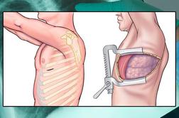 Bolnikoma prvič odstranili prizadeti del pljuč skozi en sam rez