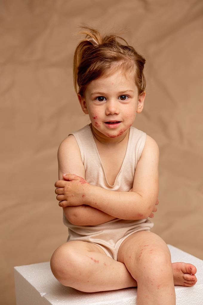 Starši otrok z atopijskim dermatitisom lahko doživljajo velike stiske. | Foto: Ines Krivec