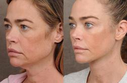 Igralka objavila fotografije pred in po liftingu obraza