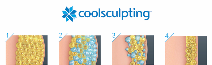 CoolSculpting poseg | Foto: 